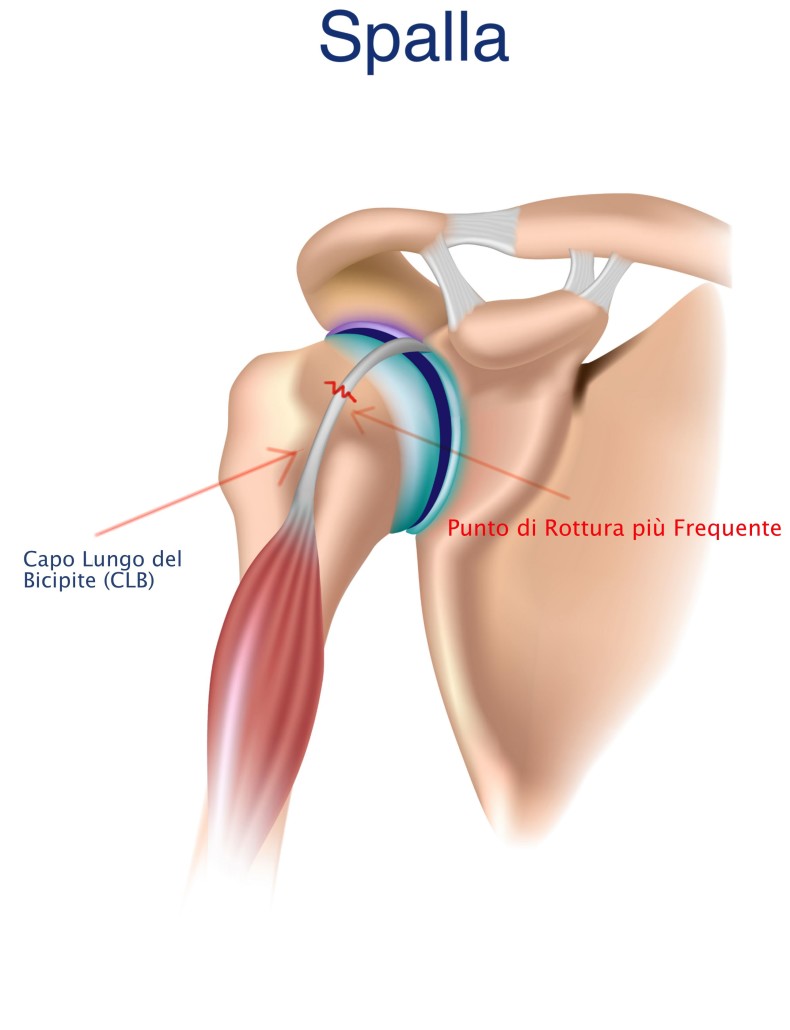 CLB spalla