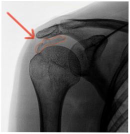 calcificazione del tendine SSP 3